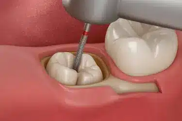 Extracción dental quirúrgica mínimamente invasiva en Clínica Dental Dr. Ferrer Murcia