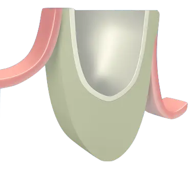 Acceso quirúrgico al seno maxilar con técnica de ventana lateral para implantes dentales