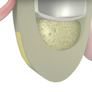 Cierre de ventana lateral con membrana tras elevación de seno maxilar para proteger injerto óseo