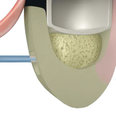 Colocación de injerto óseo tras elevación de seno maxilar para implantes dentales