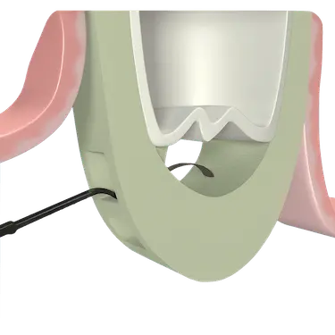 Elevación de la membrana sinusal mediante ventana lateral para implantes dentales