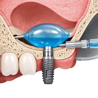 Elevación de seno maxilar con balón para facilitar la colocación de implantes dentales