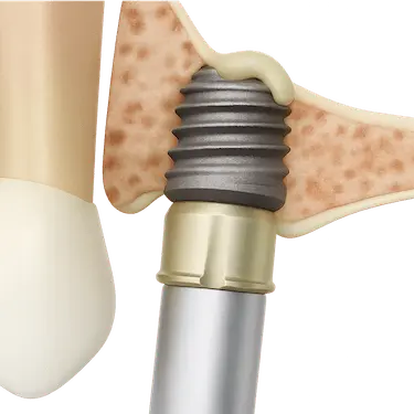 Elevación de seno maxilar con técnica cerrada para la colocación de implantes dentales