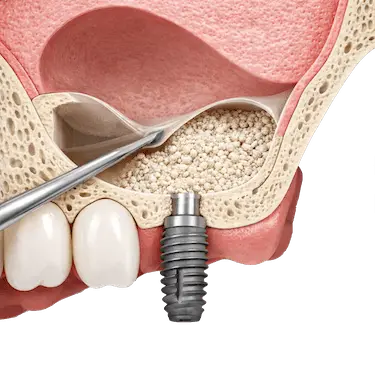 Elevación de seno maxilar por ventana lateral con injerto óseo para implantes dentales