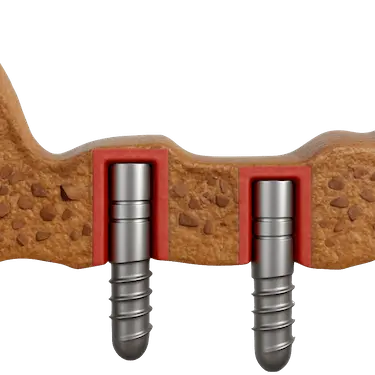 Elevación transcrestal del seno maxilar mediante cirugía guiada para implantes dentales