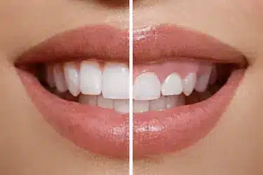 Alargamiento coronario en dientes cortos con comparación antes y después del tratamiento