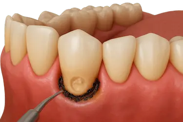 Alargamiento coronario para tratar caries subgingival y exponer la zona del diente