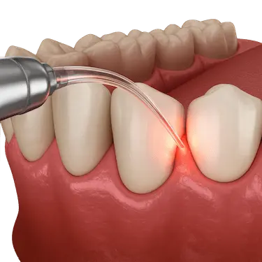 Procedimiento de alargamiento coronario con láser dental para exponer más diente