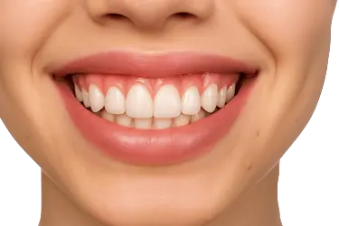 Sonrisa gingival antes del alargamiento de corona dental con exceso de encía en dientes superiores