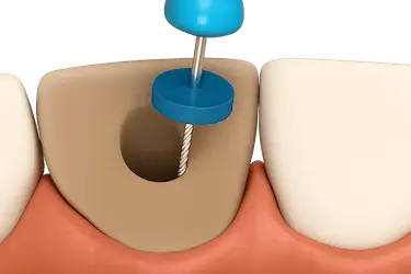 Blanqueamiento dental interno en diente con endodoncia para eliminar oscurecimiento interno