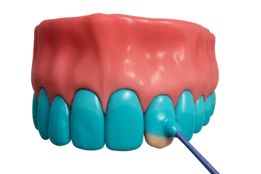 Aplicación de gel blanqueador con luz LED en blanqueamiento dental profesional