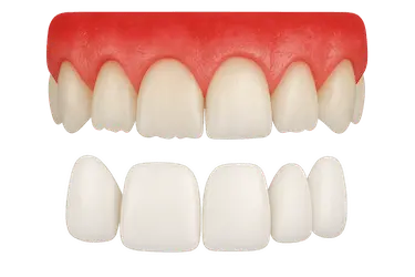 Colocación de carillas dentales en dientes frontales para mejorar color y estética de la sonrisa