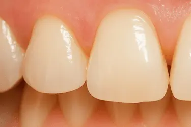 Primer plano de dientes con esmalte desgastado y dentina amarillenta visible