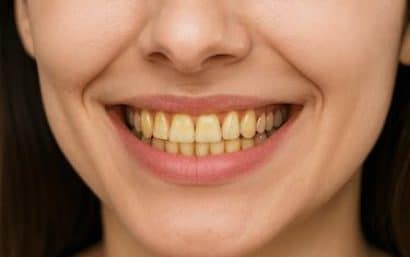 Mujer sonriendo con dientes amarillentos visibles por alteración del color dental