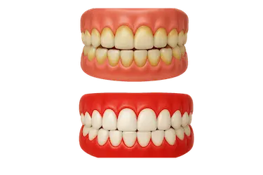Antes y después de una limpieza dental profesional para eliminar manchas y dientes amarillos