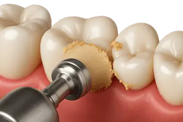 Resultado de microabrasión dental para eliminar manchas y recuperar el brillo del esmalte