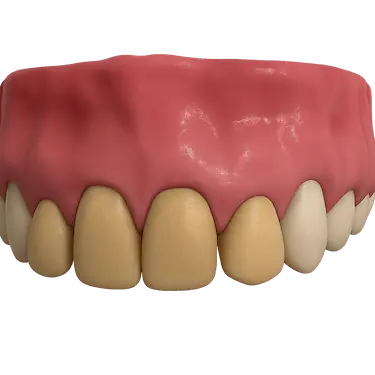 Esmalte dental amarillento visible en dientes superiores, alteración del color dental