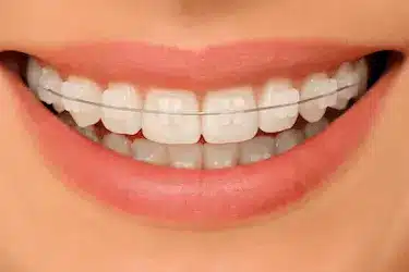 Brackets cerámicos blancos en ortodoncia estética en Madrid con el Dr. Ferrer