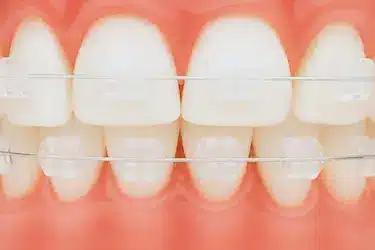 Brackets estéticos de circonio blancos en ortodoncia estética en Madrid con Dr. Ferrer