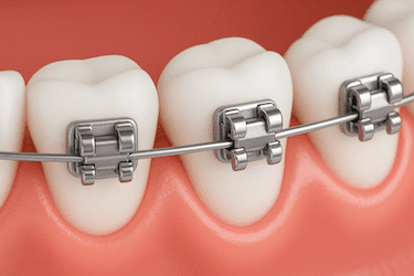 Brackets autoligables metálicos sobre dientes con encía rosada en diseño 3D CAD-CAM