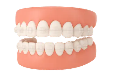 Modelo 3D de dientes con brackets estéticos transparentes tipo zafiro en ortodoncia dental