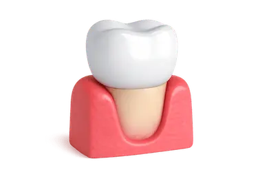 Corona dental colocada sobre diente natural para proteger y restaurar una pieza dañada