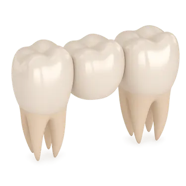 Puente dental provisional con coronas temporales para proteger los dientes tallados