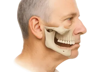 Hombre mayor con pérdida ósea mandibular inferior que dificulta la colocación de implantes