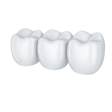 Colocación del puente dental definitivo con tres coronas fijas sobre dientes tallados