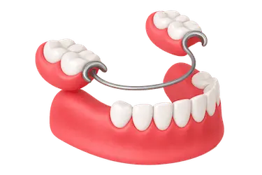 Prótesis parcial removible sin implantes para sustituir varios dientes de forma cómoda y funcional