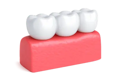 Puente dental fijo apoyado sobre dientes naturales para reemplazar piezas ausentes