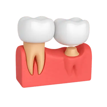 Puente dental voladizo tipo cantilever apoyado en un solo diente pilar