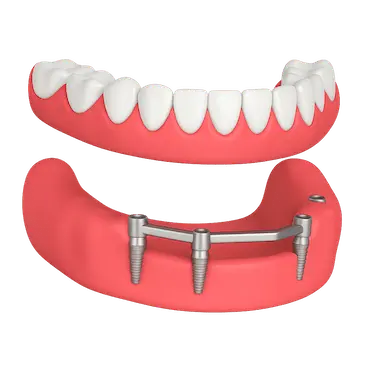 Sobredentadura sobre barra Ackerman fijada a implantes dentales