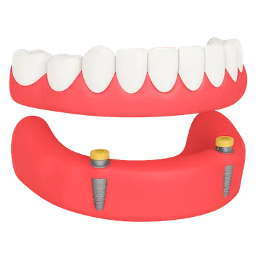 Sobredentadura inferior con 2 implantes y sistema Locator