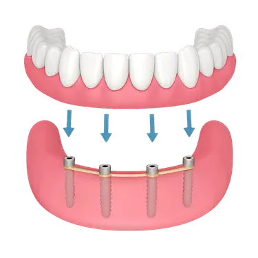 Ajuste de sobredentadura sobre implantes dentales en la mandíbula inferior con barra de retención