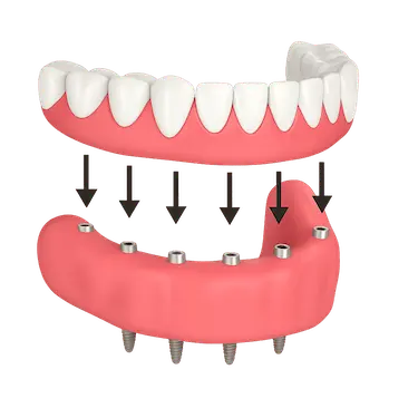 Colocación de una prótesis dental híbrida definitiva sobre implantes