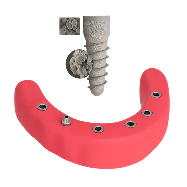 Implante dental con vista ampliada del proceso de osteointegración en el hueso