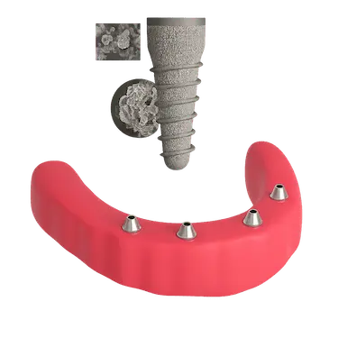 Proceso de osteointegración de implantes dentales en sobredentadura con Dr. Ferrer