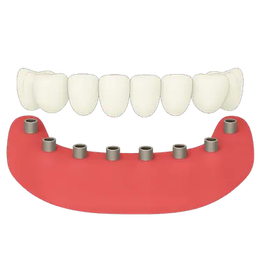 Prótesis dental fija completa de porcelana con coronas sobre implantes en Madrid