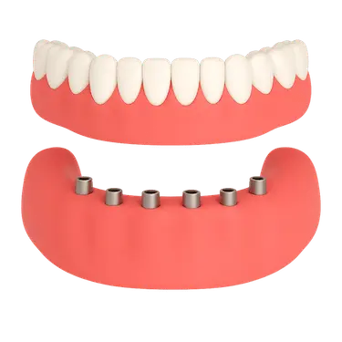 Prótesis dental híbrida completa sobre seis implantes en Madrid