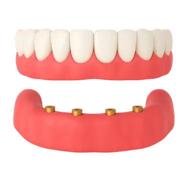 Prótesis dental completa removible sobre implantes tipo sobredentadura en Madrid