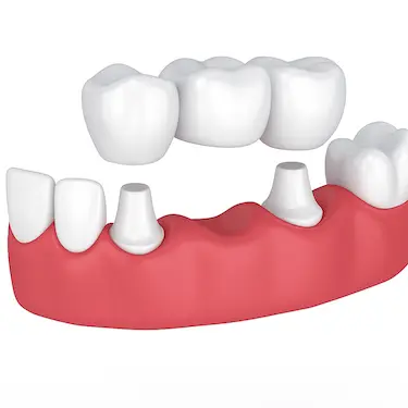 Puente dental fijo de tres piezas sobre dientes tallados en Murcia, Clínica Dr. Ferrer