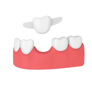 Puente dental Maryland adherido con aletas a dientes vecinos para reemplazar un diente