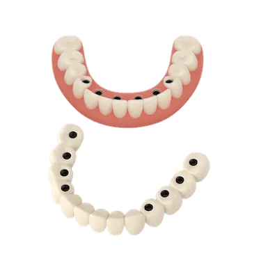 Prótesis completas con implantes fijas de porcelana y opción removible.