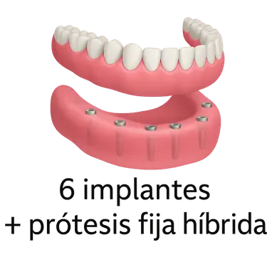 Prótesis fija híbrida sobre 6 implantes en la arcada inferior