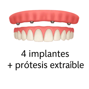 Sobredentadura sobre implantes para arcada completa