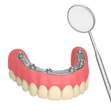 Revisión y mantenimiento de prótesis híbrida sobre implantes para garantizar su durabilidad