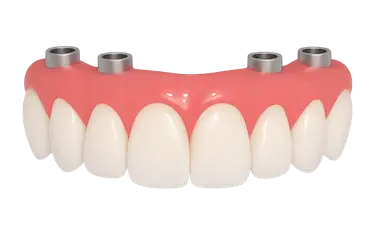 Sobredentadura removible sobre 4 implantes en arcada superior en Madrid, Dr. Ferrer