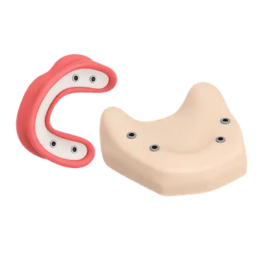 Diseño personalizado de sobredentadura con impresiones digitales y análogas por Dr. Ferrer