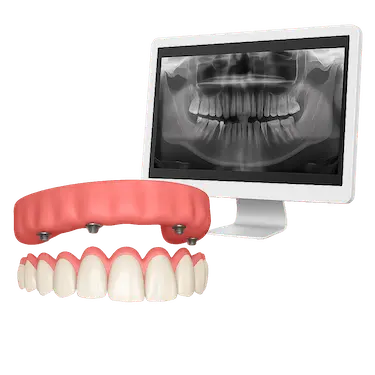 Exploración y TAC dental para diagnóstico de sobredentadura sobre implantes